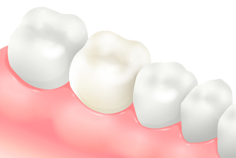セラミッククラウン